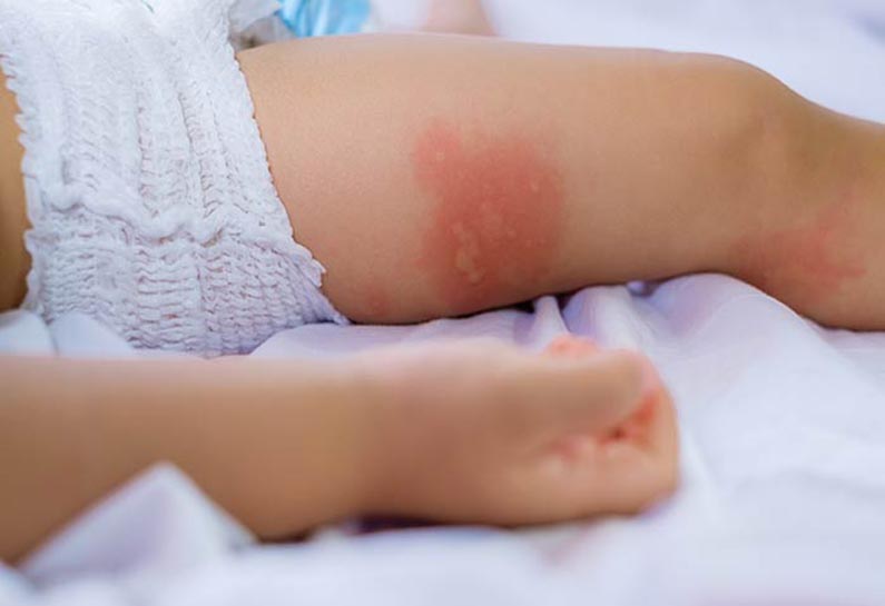 how to treat diaper rash